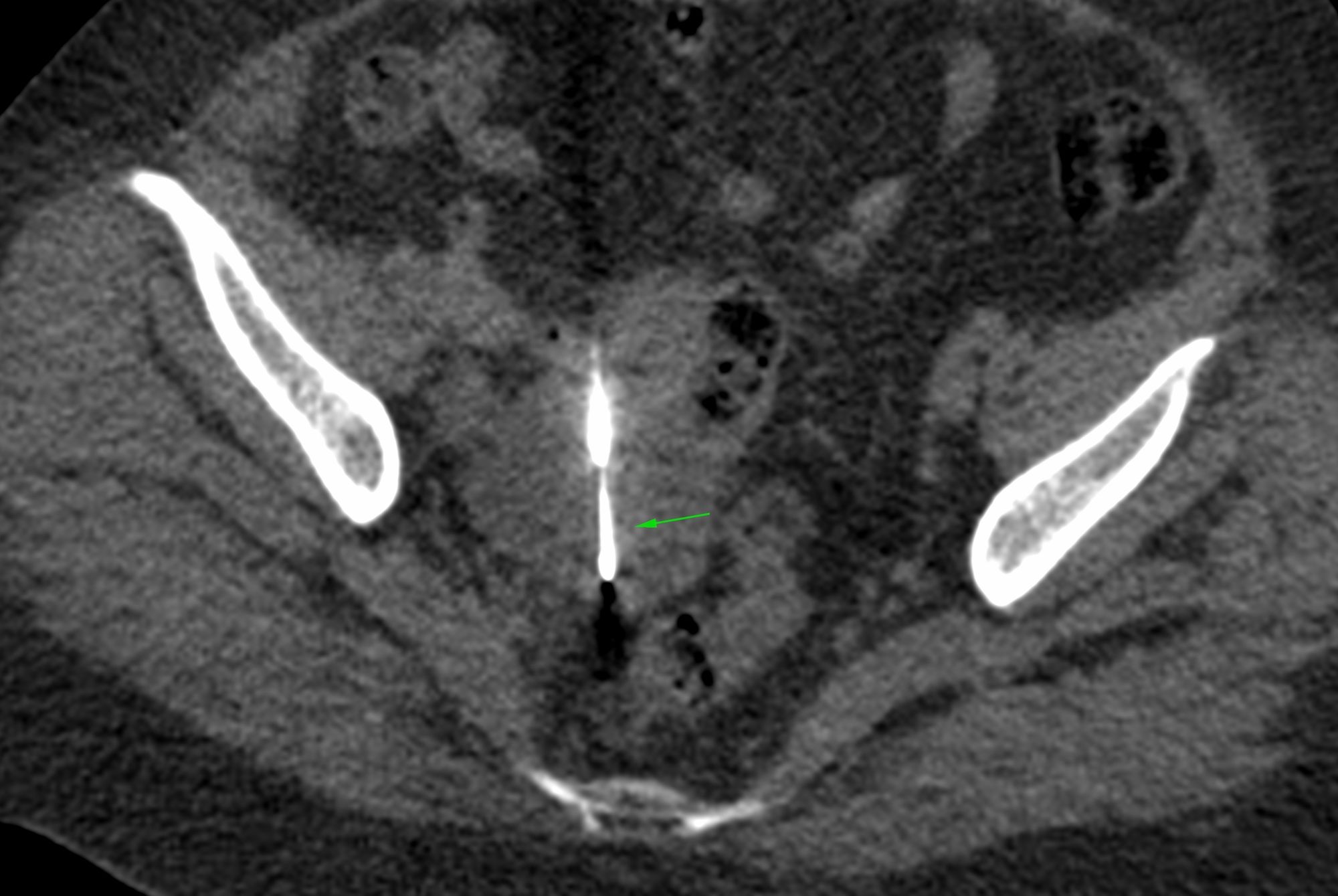 Case 48: Ovarian Mass Biopsy – Approach – Anterior or Posterior?