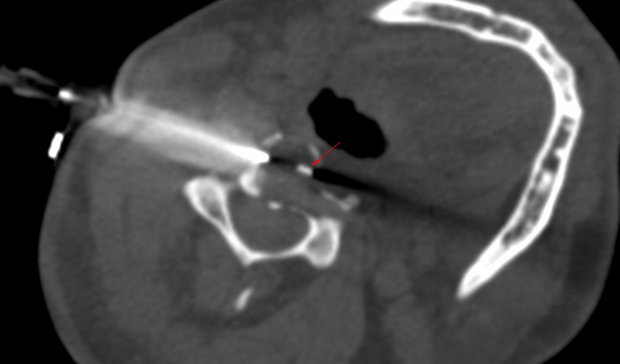 Case 54: C3 Vertebral Body Lesion Biopsy Using a Far Posterolateral Approach