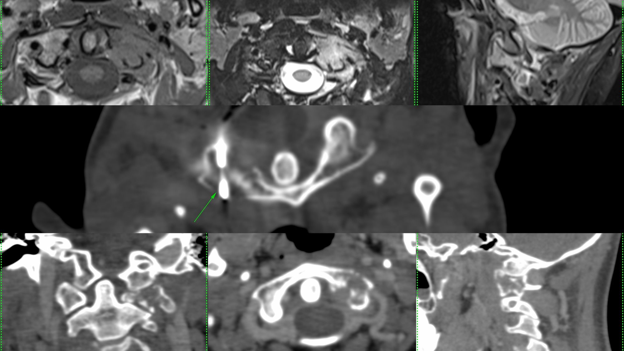 Case 55: C1 Lateral Mass Biopsy Using a Posterior Approach