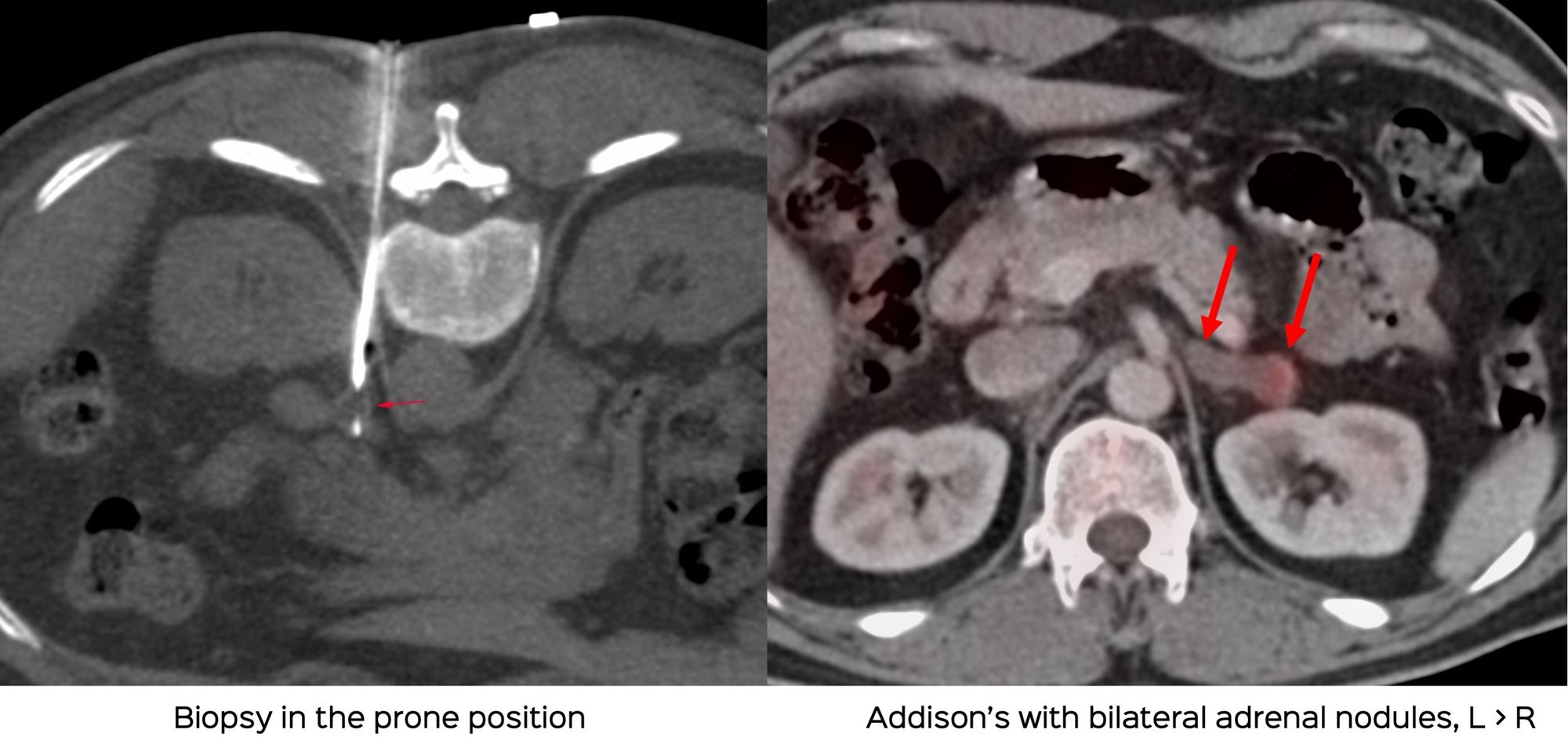 Case 56: Adrenal Gland - Small Nodule Biopsy in the Prone Position