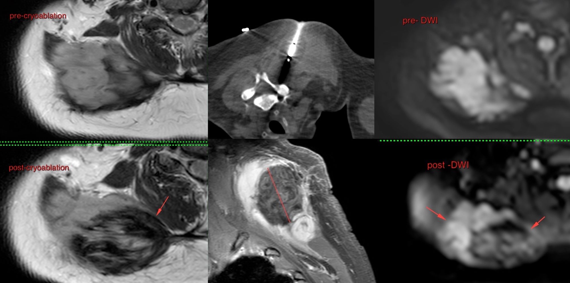 Case 53: Cryoablation of Extra-Abdominal Thoracic Wall Fibromatosis