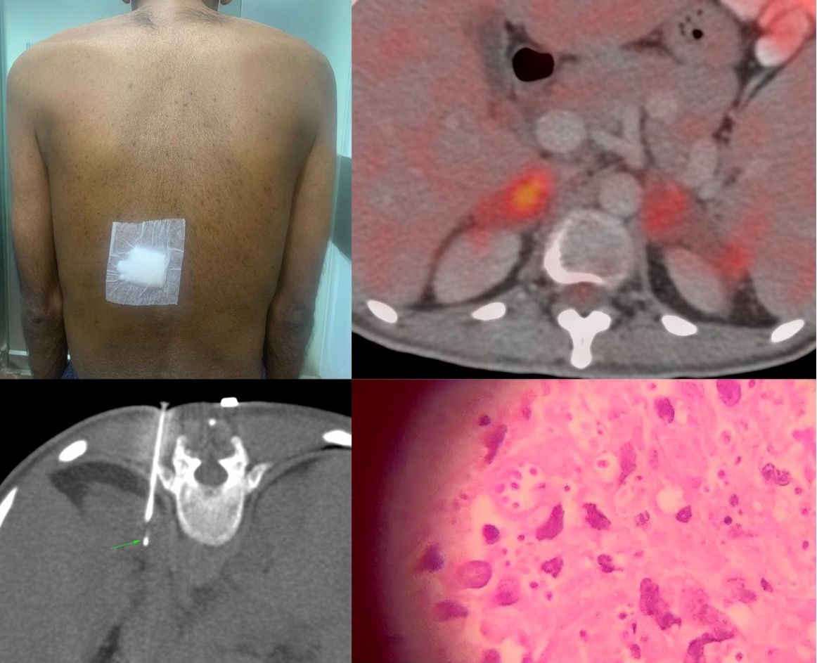 Case 57: Adrenal Gland Biopsy in Addison's Disease - The Microbiology Lessons