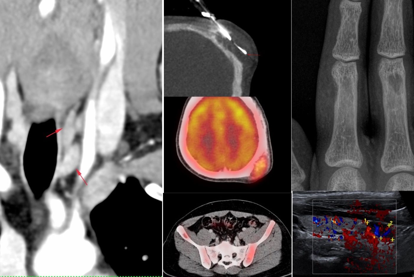 Case 59: When the Parietal Skull Bone Biopsy was Just the Tip of the Iceberg