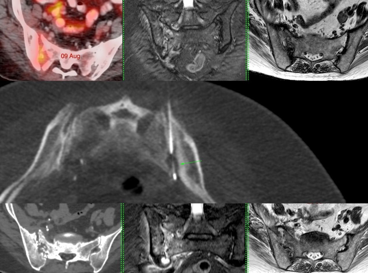 Case 60: Sacroiliac Joint Biopsy