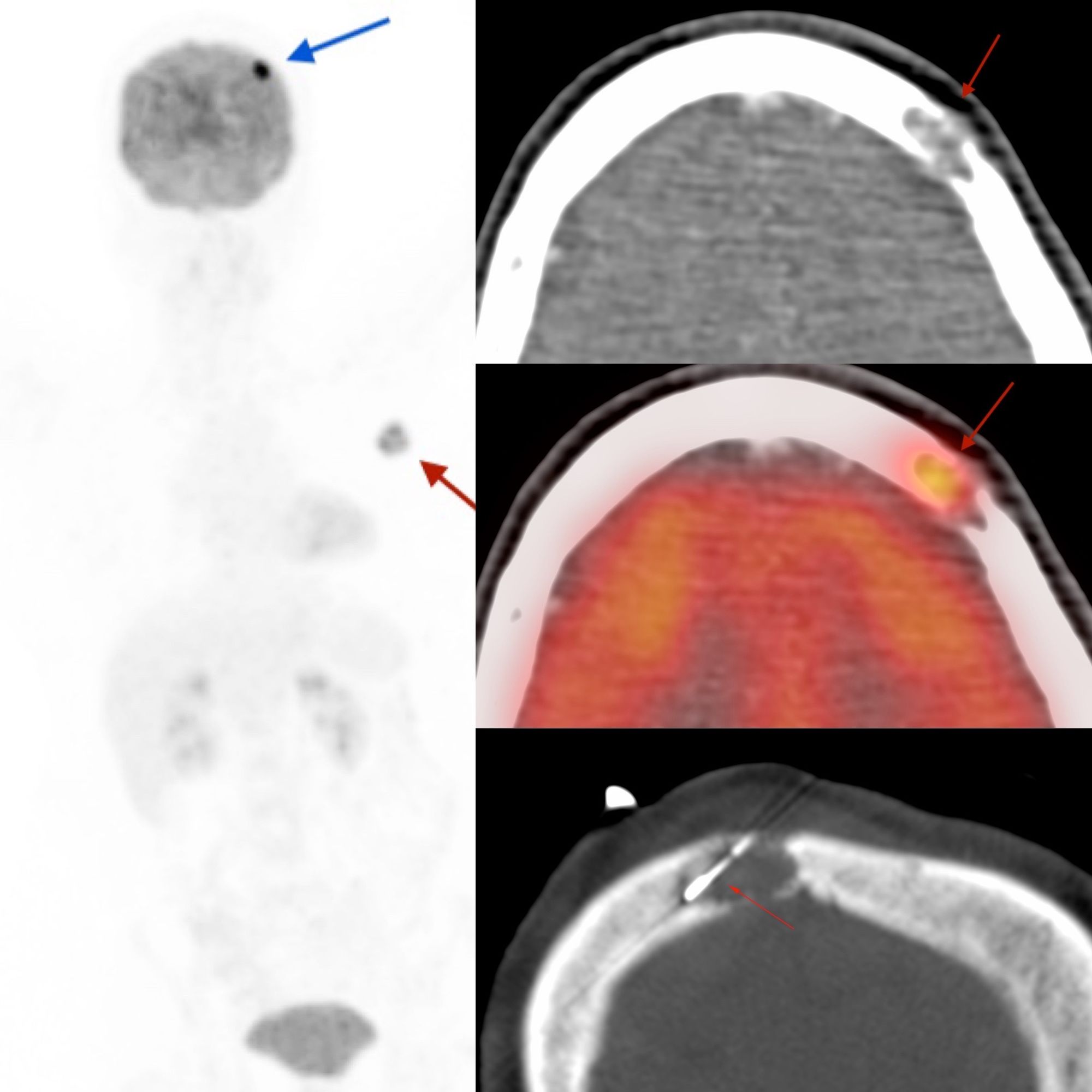 Case 58: Left Frontal Skull Bone Osteolytic Lesion Biopsy in a patient with Ca Breast