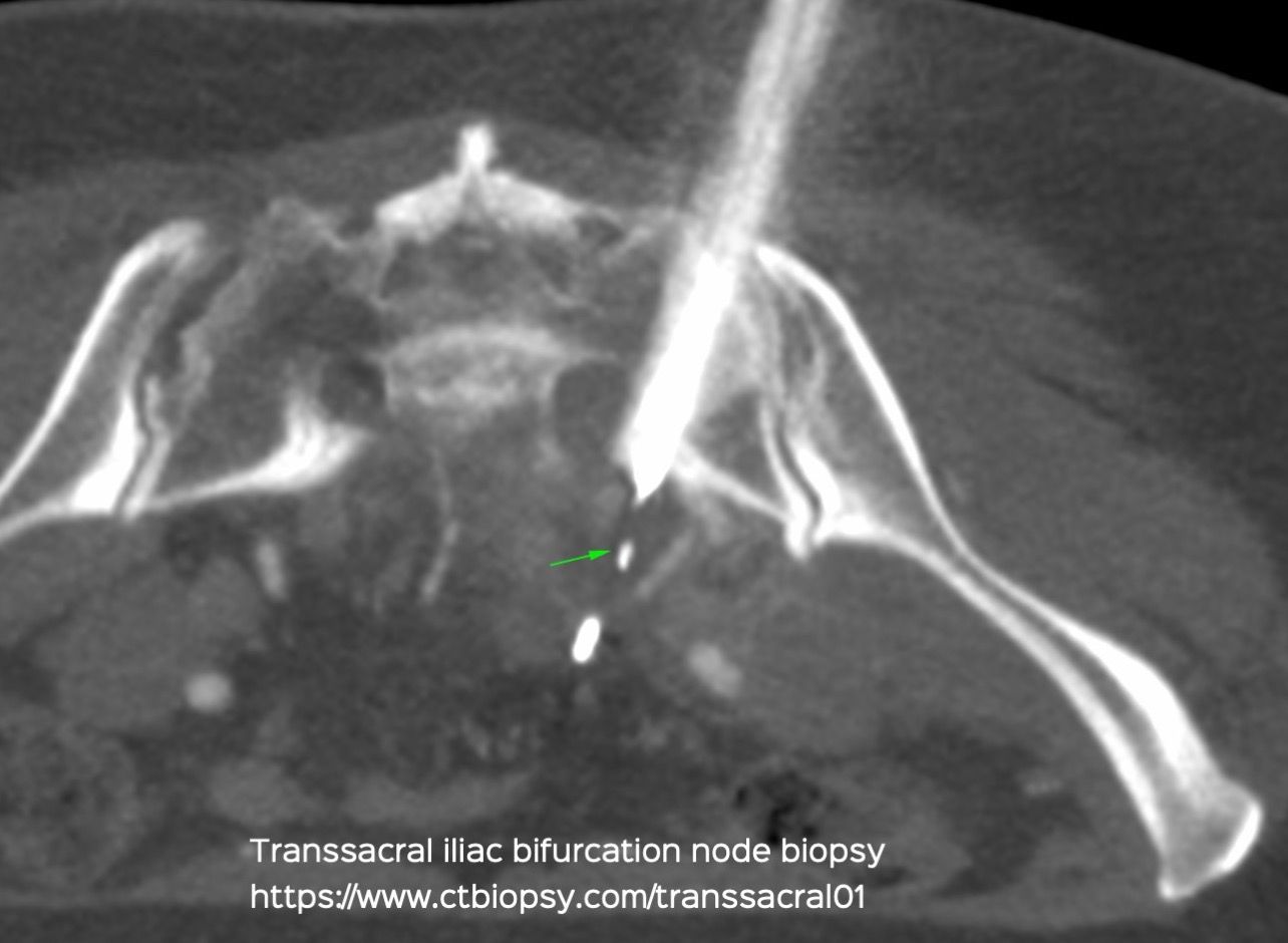 Case 62: Transsacral Biopsy for Iliac Nodes