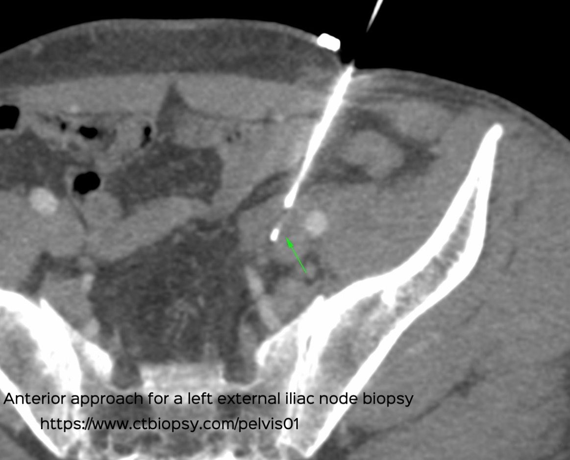 Case 63: Anterior Approach for Iliac Node Biopsy