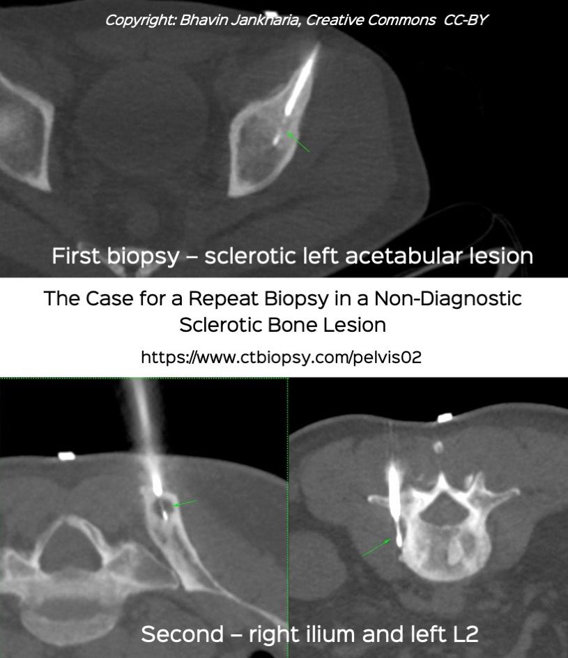 Case 64: The Case for a Repeat Biopsy in a Non-Diagnostic Sclerotic Bone Lesion