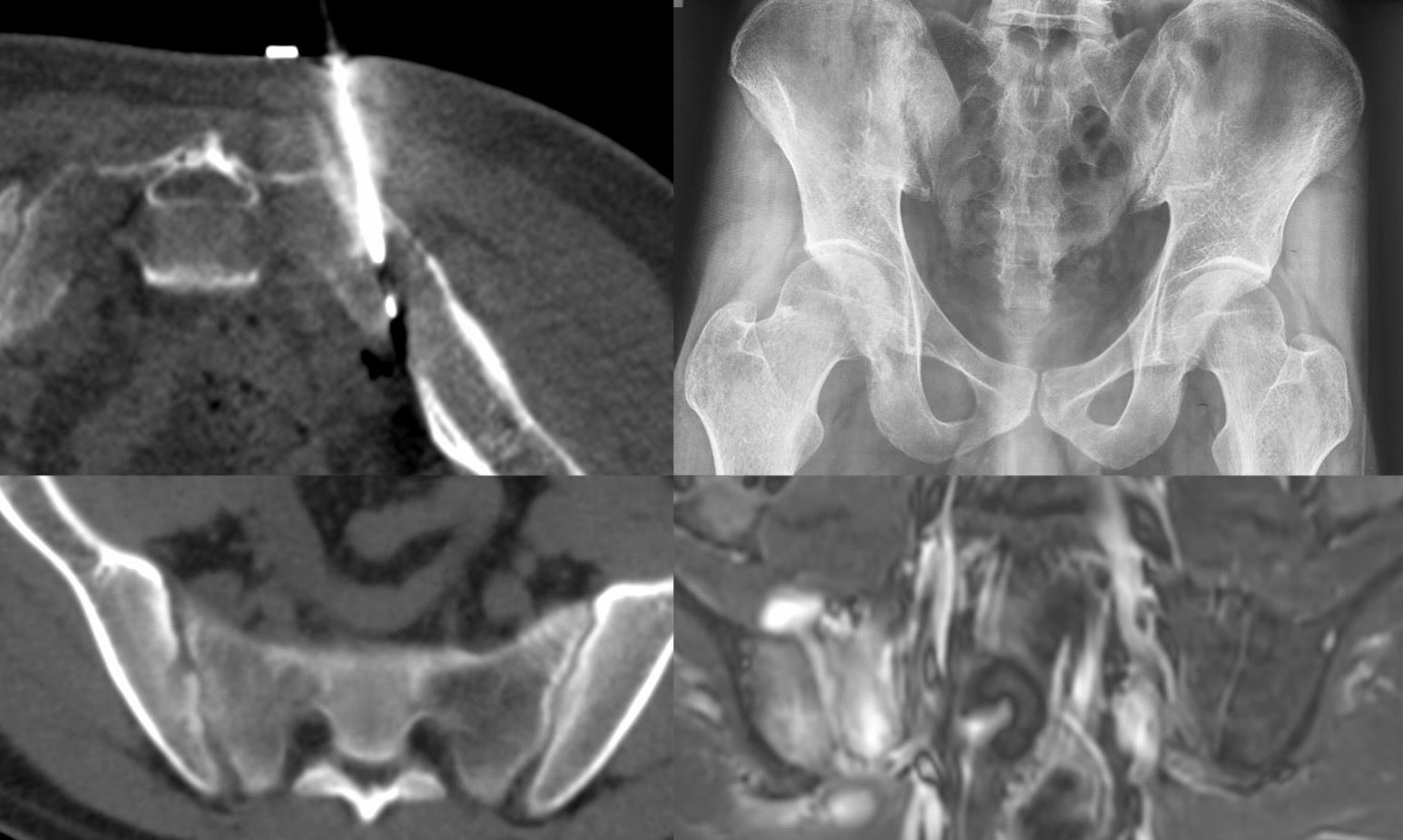 Case 61: Sacroiliac Joint Biopsy in Mild to Moderate Sacroilitis
