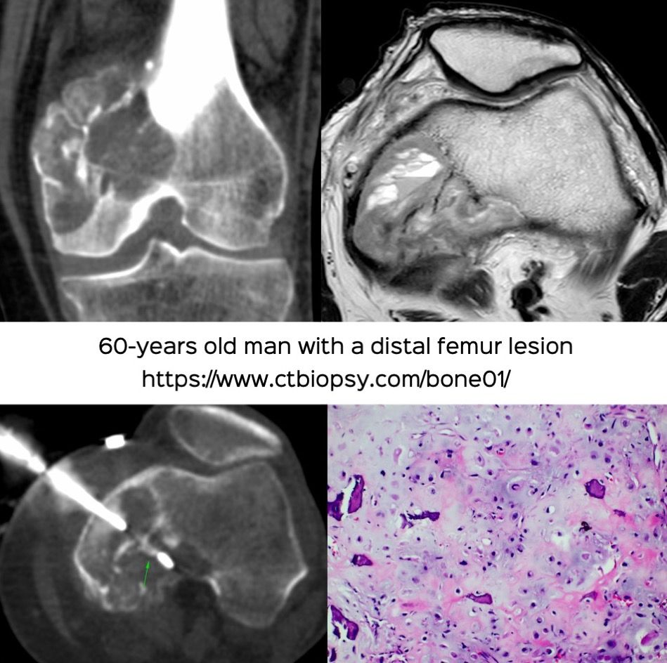 Case 66: The Rule for Bone Tumor Biopsies