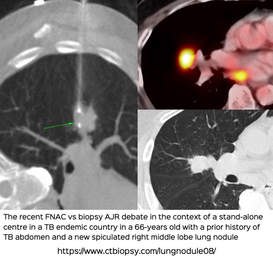 Case 67: Lung Nodule - FNAC vs Biopsy – The Recent Debate in the AJR in the Context of a Deep Lung Nodule Biopsy