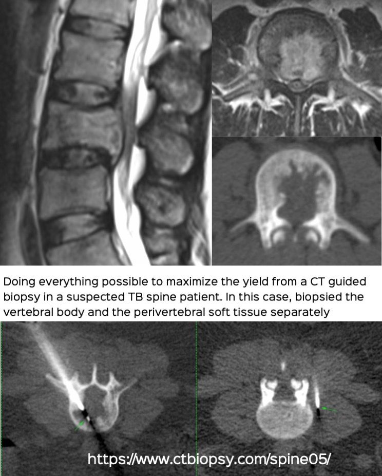 Case 68: How to Maximize Your Yield in a Suspected TB Spine Biopsy