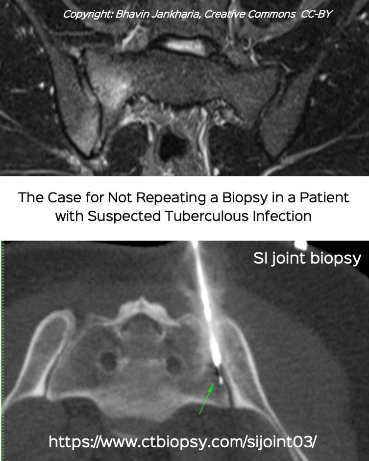 Case 65: The Case for Not Repeating a Biopsy in Suspected Tuberculous Infections