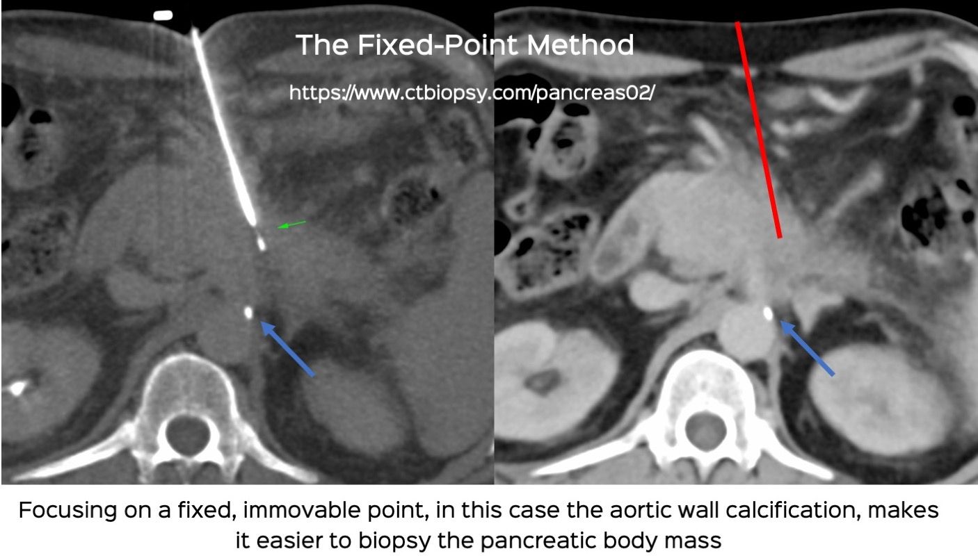 Case 70: Tips and Tricks to Easily Biopsy a Seemingly Difficult Pancreatic Body Mass - The Fixed Point Method