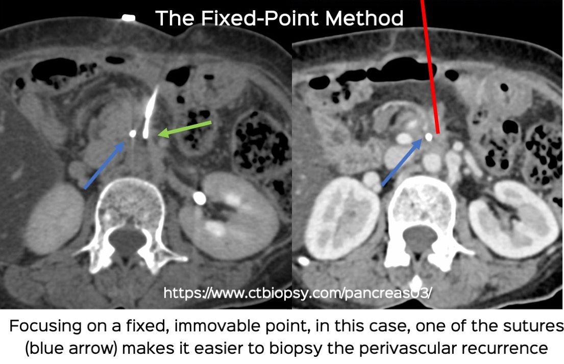 Case 71: The Fixed Point Method – II. Biopsy of a Perivascular Recurrent Pancreatic Adenocarcinoma