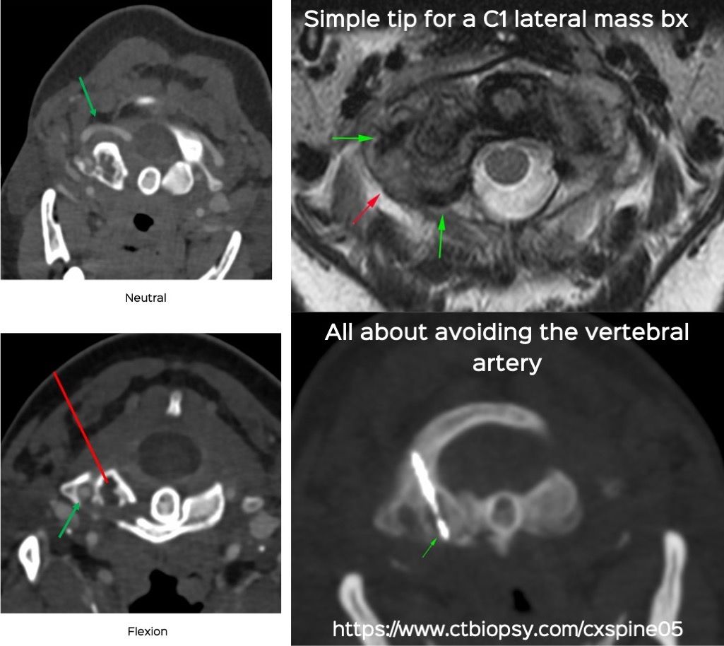 Case 72: A Tip to Simplify a C1 Lateral Mass Biopsy