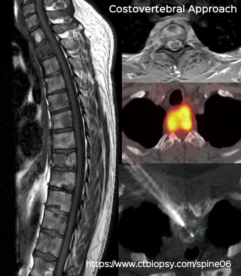 Case 73: The Costovertebral Approach for Dorsal Vertebral Body Biopsies