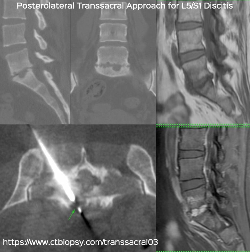 Case 75: L5/S1 Discitis - Biopsy using a Posterolateral Transsacral Approach