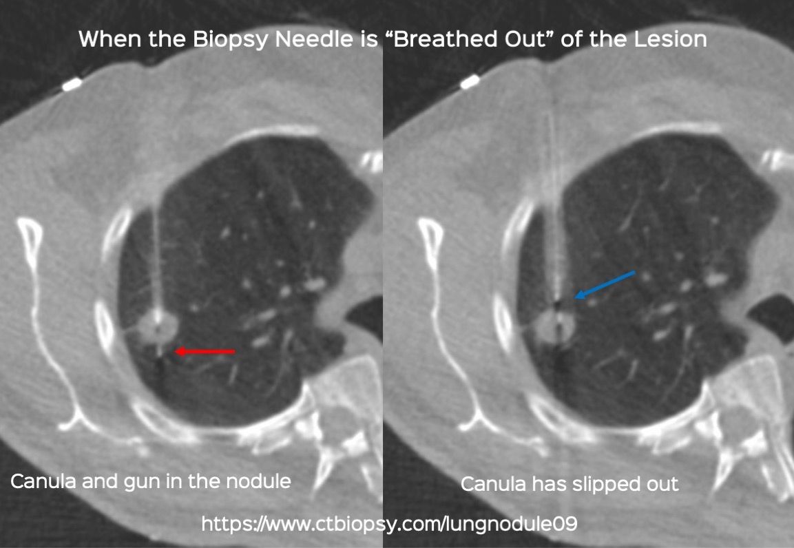 Case 76: When the Biopsy Needle is "Breathed Out" Of the Lesion