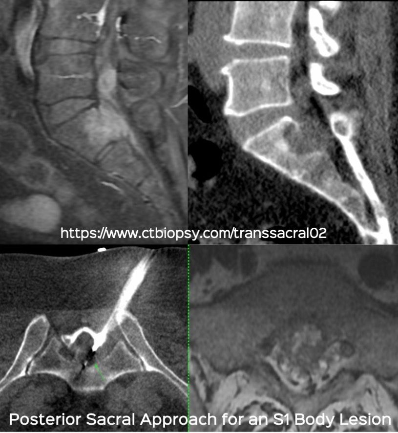 Case 74: S1 Body Biopsy Using a Posterior Approach