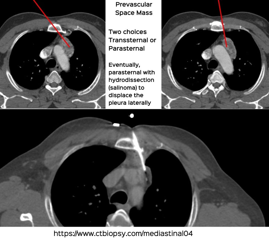 Case 77: Prevascular Space Mediastinal Mass Biopsy Using a Parasternal Approach with Hydrodissection (Salinoma)
