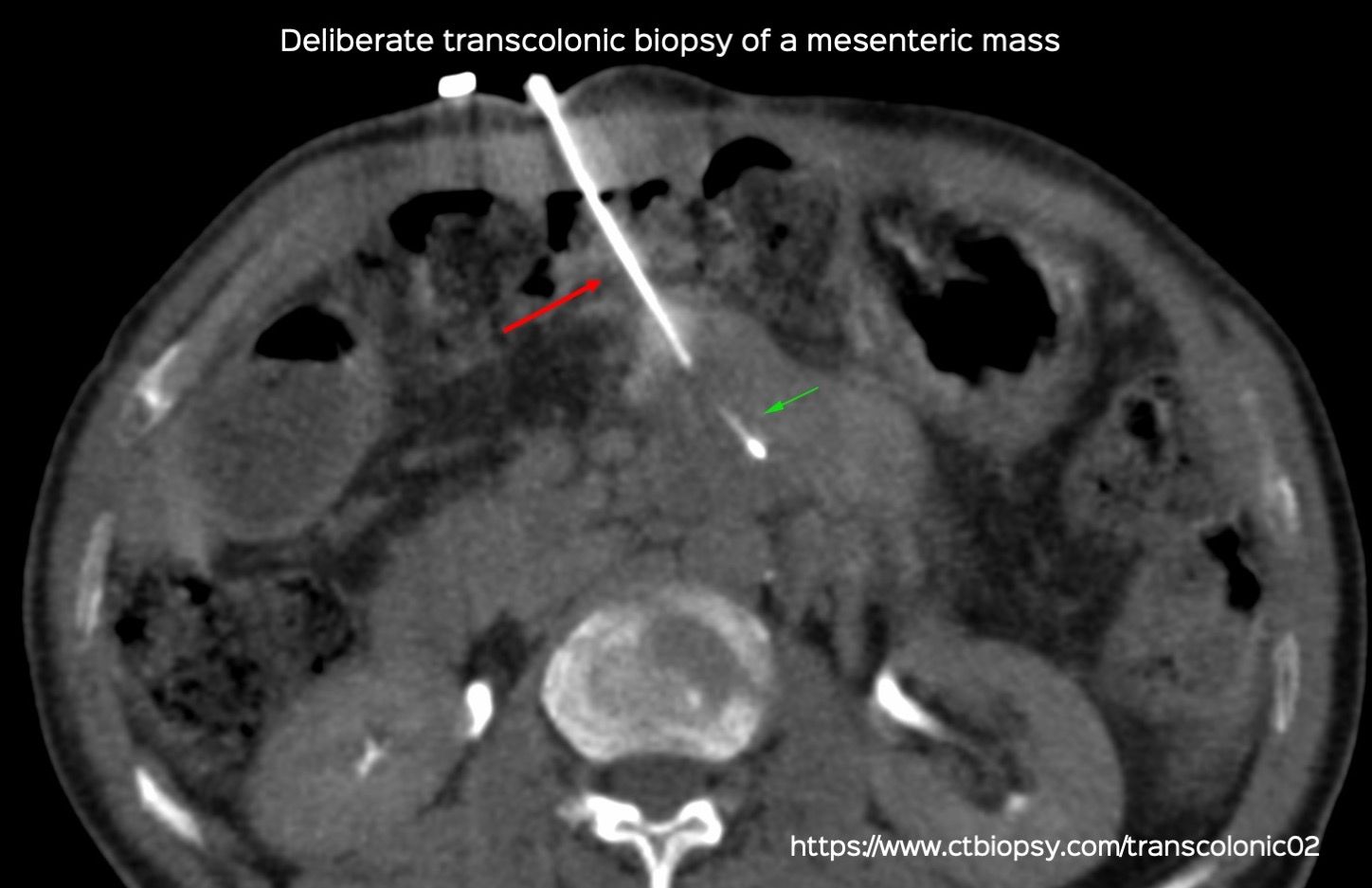 Case 80: Deliberate Transcolonic Biopsy of a Mesenteric Mass