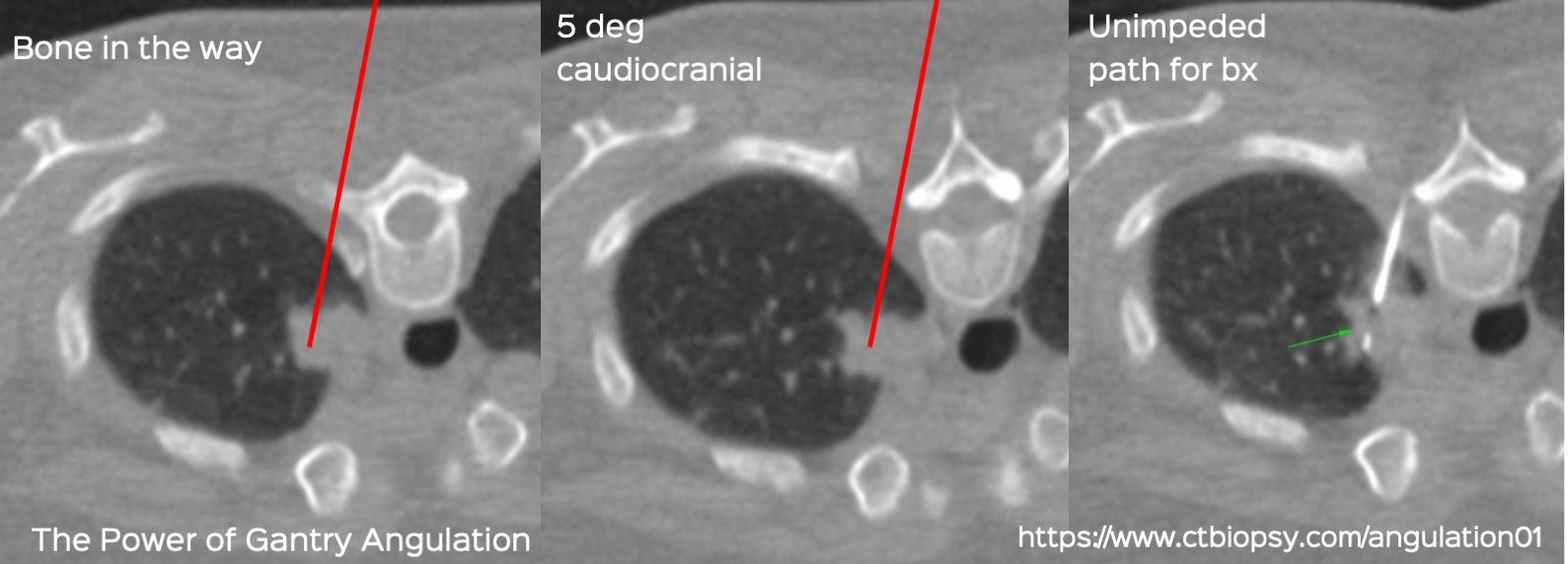 Case 81: The Power of Gantry Angulation