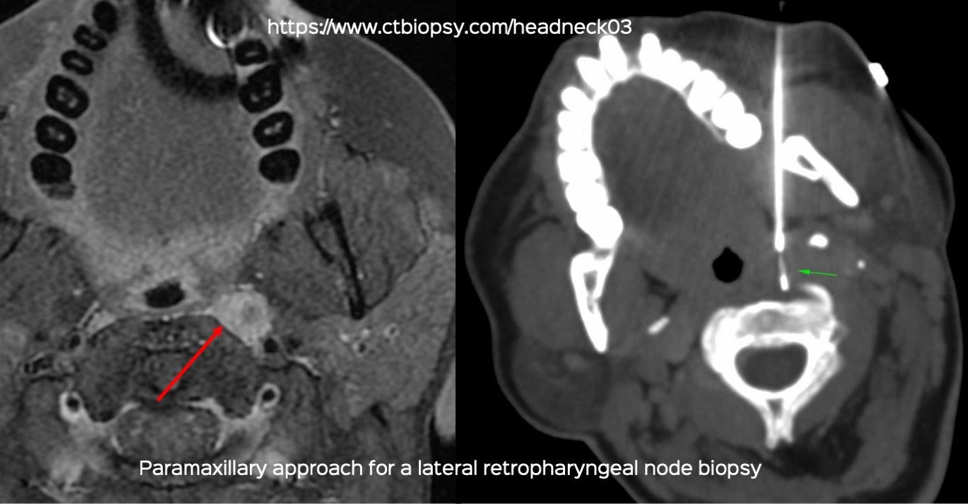 Case 78: Lateral Pharyngeal / Retropharyngeal Lesion Biopsy with a Paramaxillary Approach