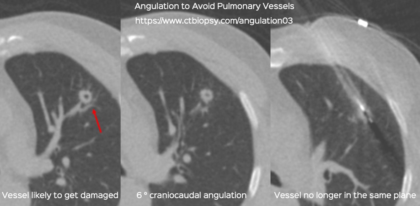 Case 83: Angulation to Avoid Pulmonary Vessels