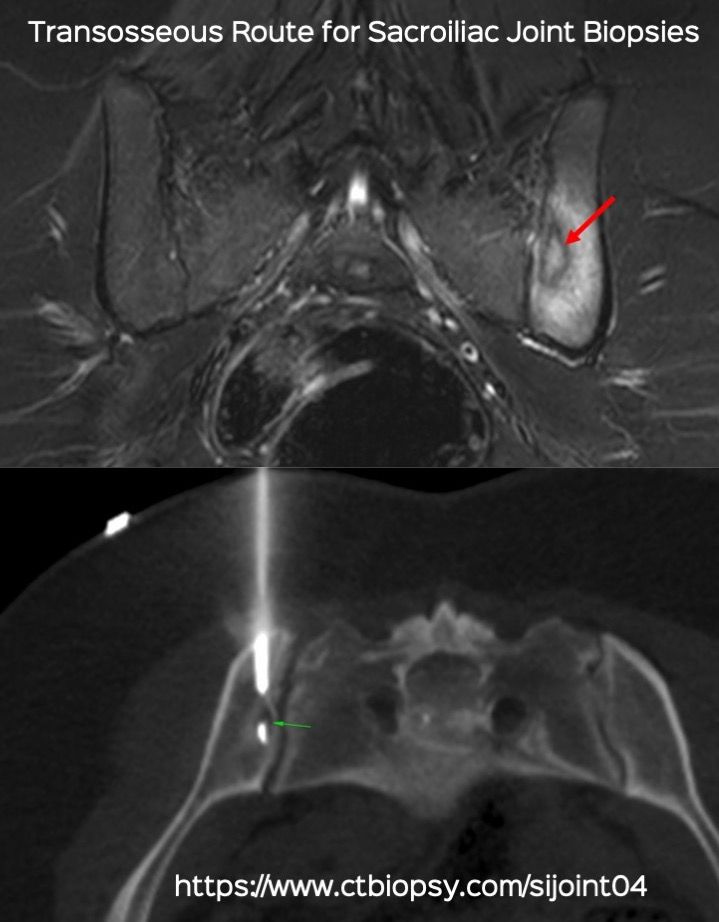 Case 84: Transosseous Route for Sacroiliac Joint Biopsy