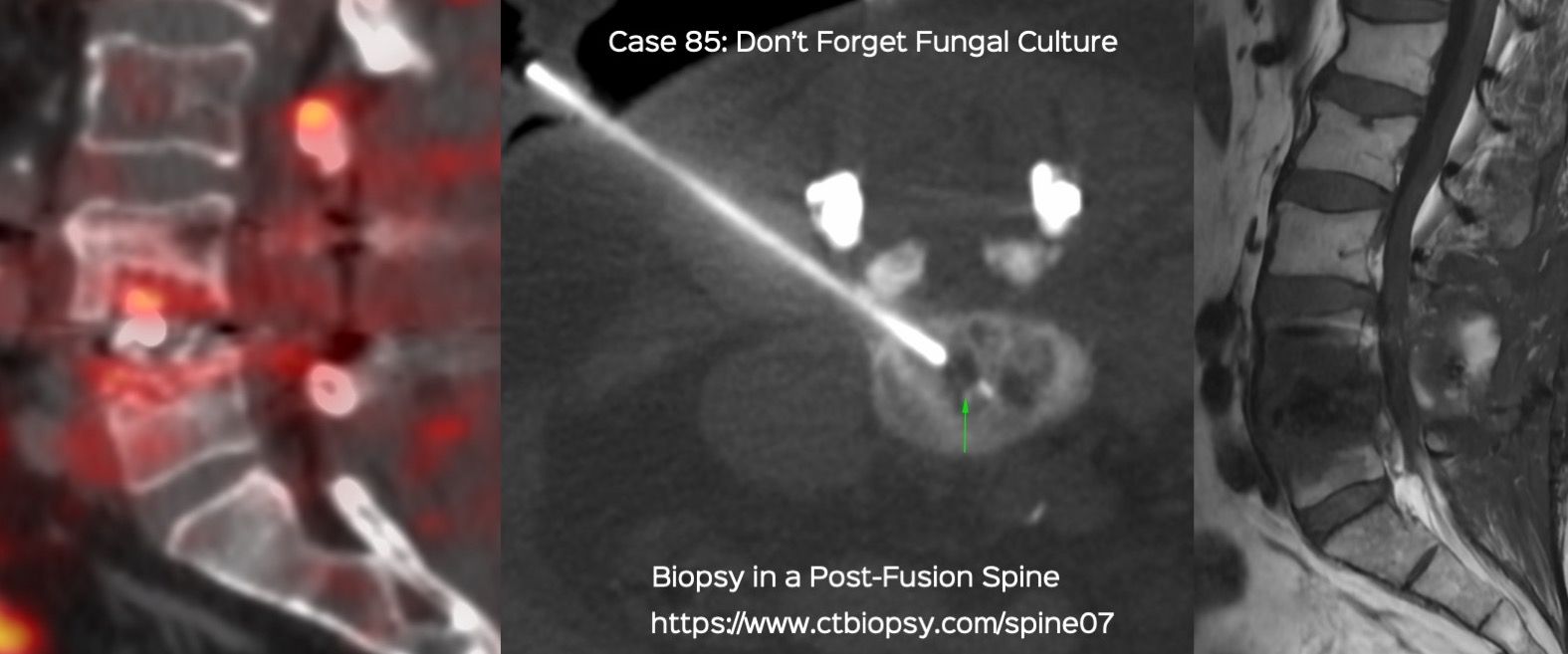 Case 85: Don't Forget Fungal Culture - Biopsy of a Post-Fusion Surgery Spine