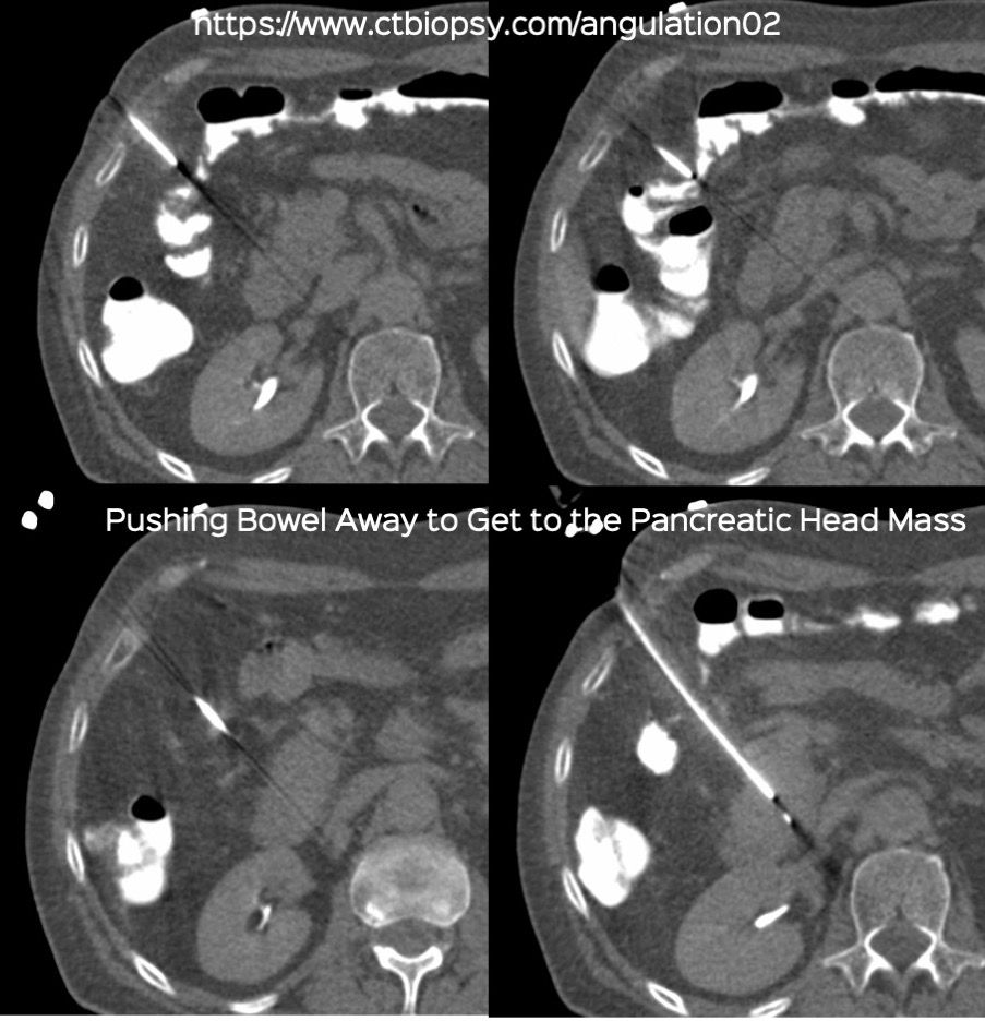 Case 82: Displacing Bowel