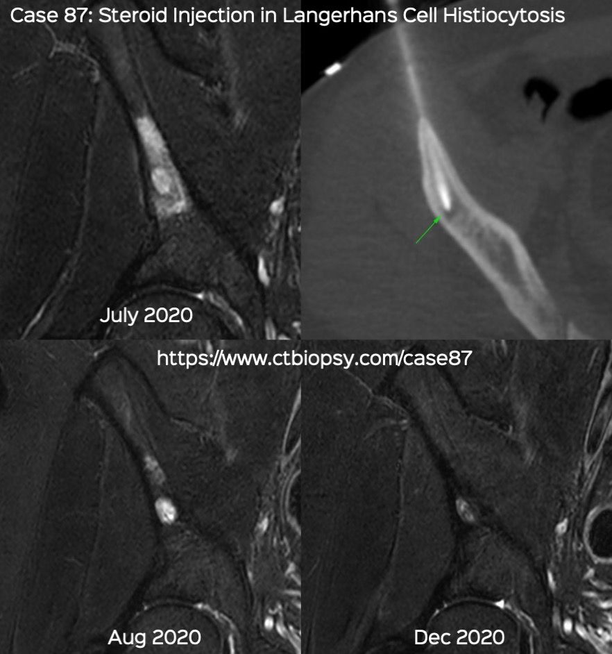 Case 87: Intra-Lesional Steroid Injection in Langerhans Cell Histiocytosis