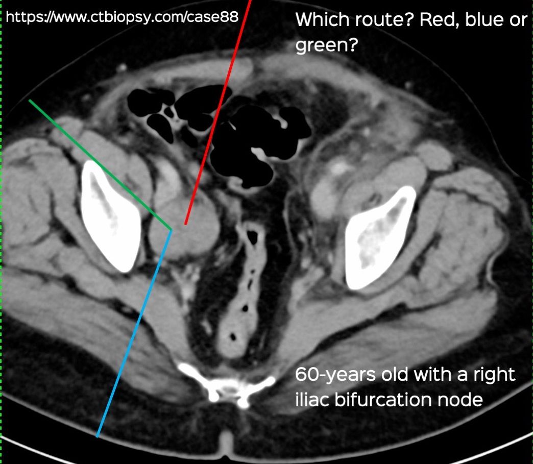 Case 88: Transiliopsoas Route for Iliac Bifurcation Node Biopsy