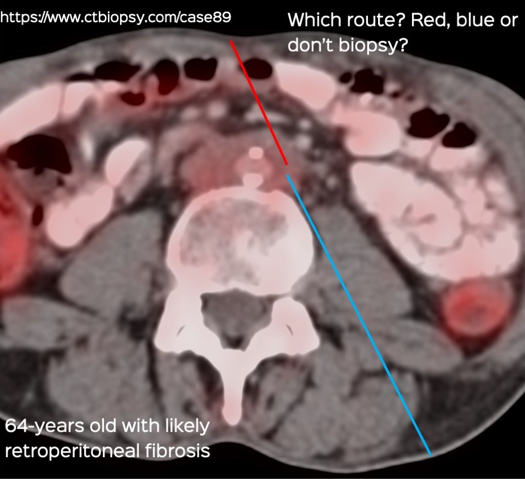 Case 89: Biopsy of Retroperitoneal Fibrosis