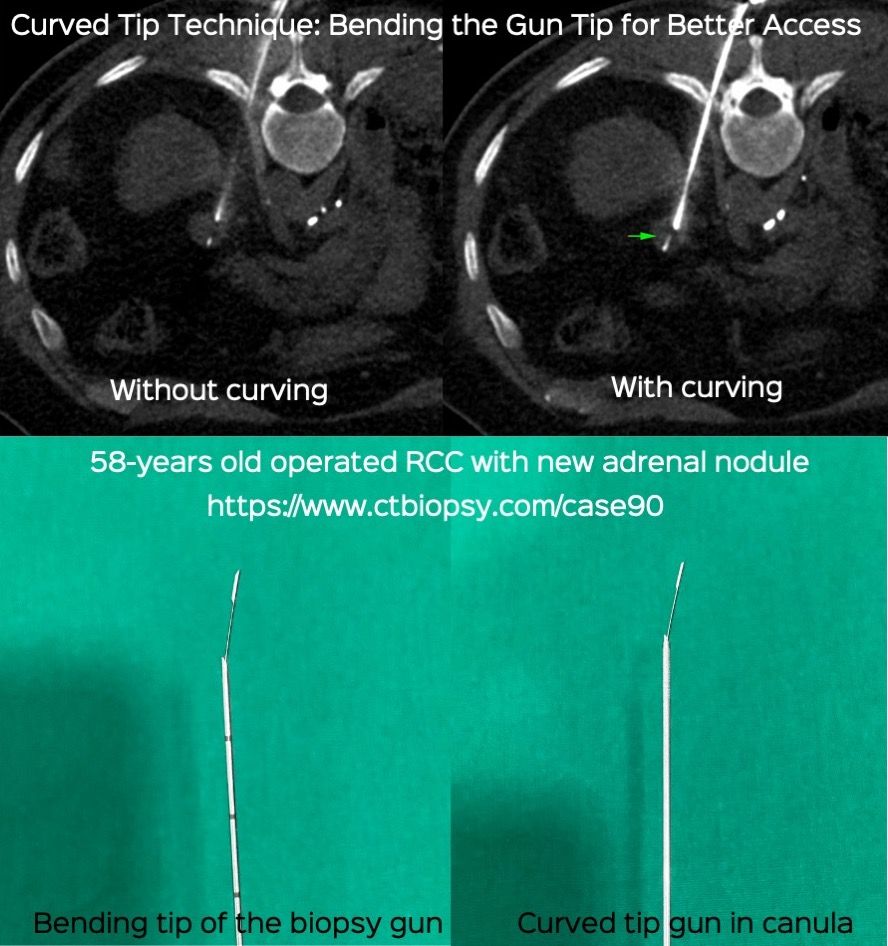 Case 90: Bending the Needle - Curved Needle Technique for an 18.4 mm Left Adrenal Nodule Biopsy