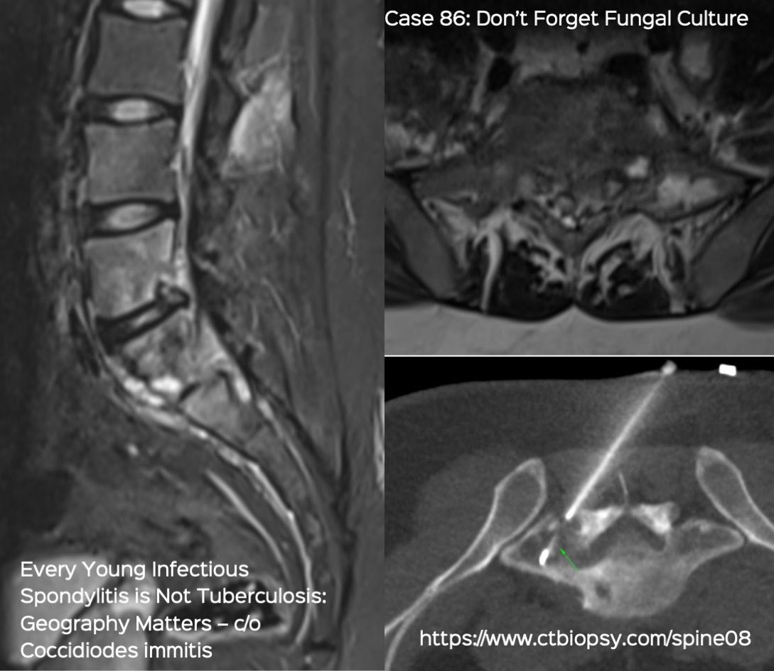 Case 86: Every Young Infectious Spondylitis is not Tuberculosis: Geography Matters