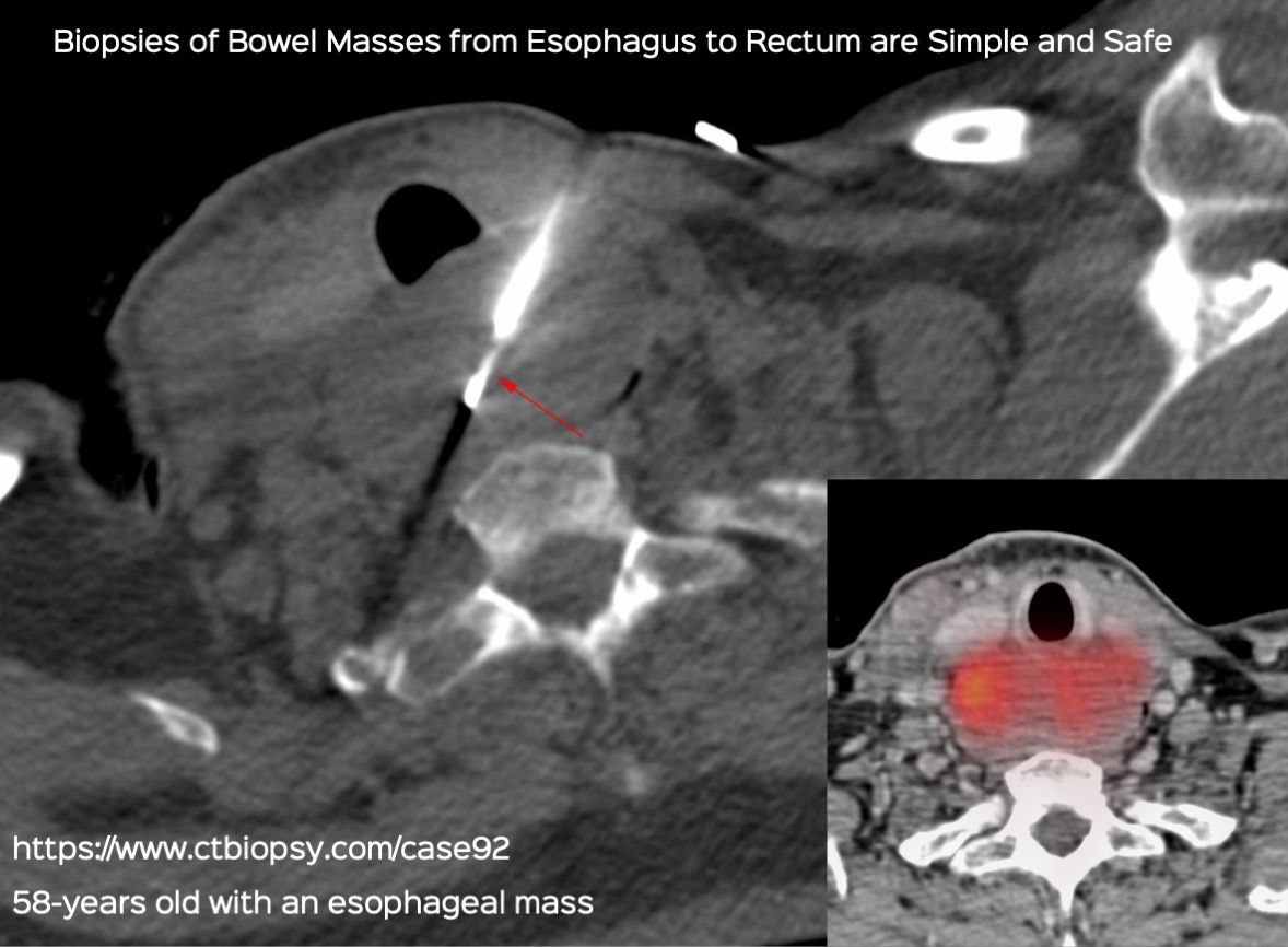 Case 92: Esophageal Mass Biopsy