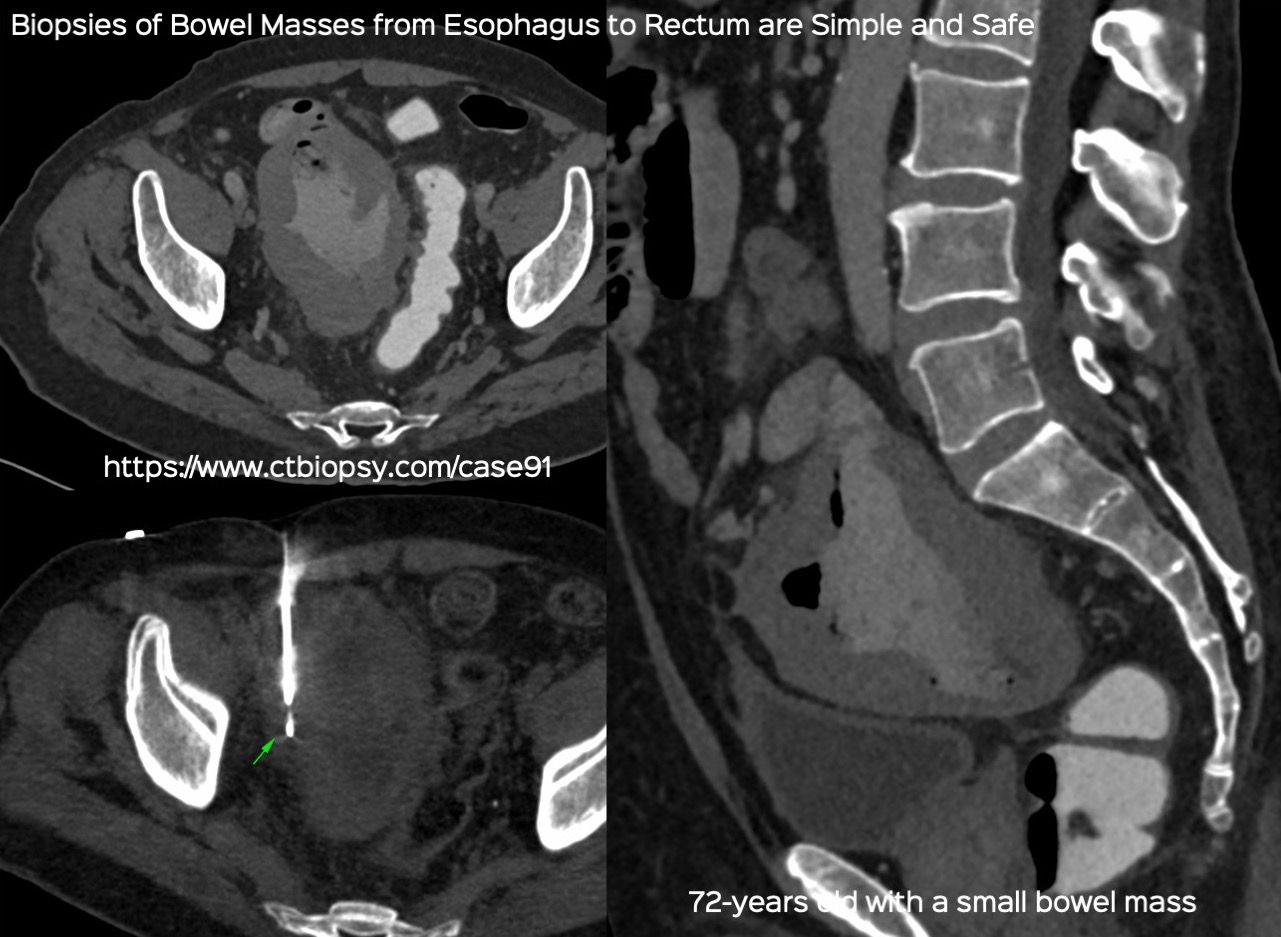 Case 91: Small Bowel Mass Biopsy