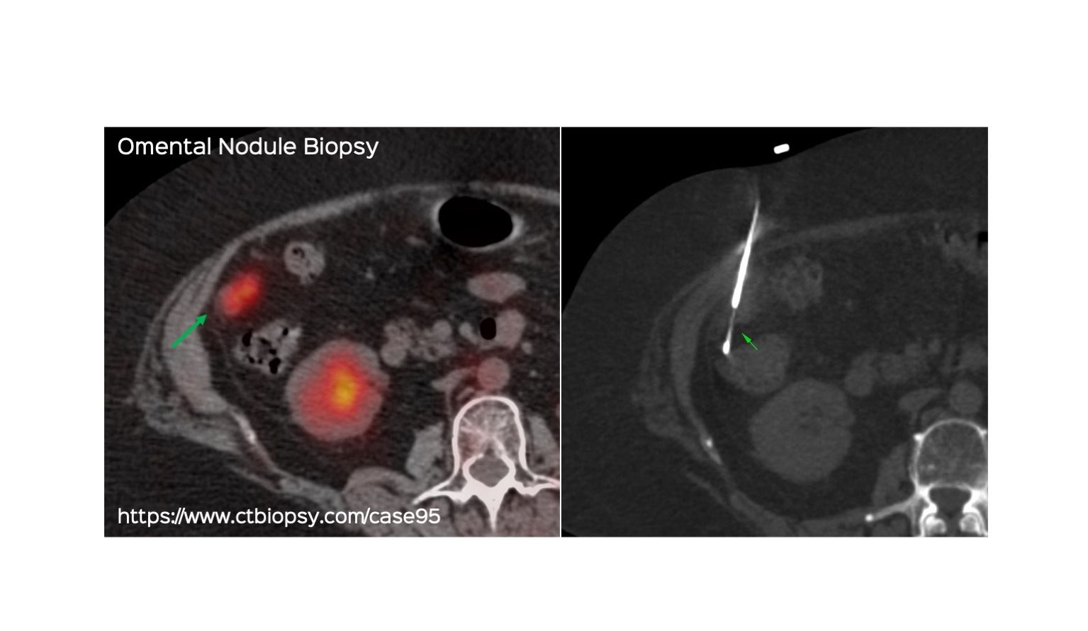 Case 95: Omental Nodule Biopsy