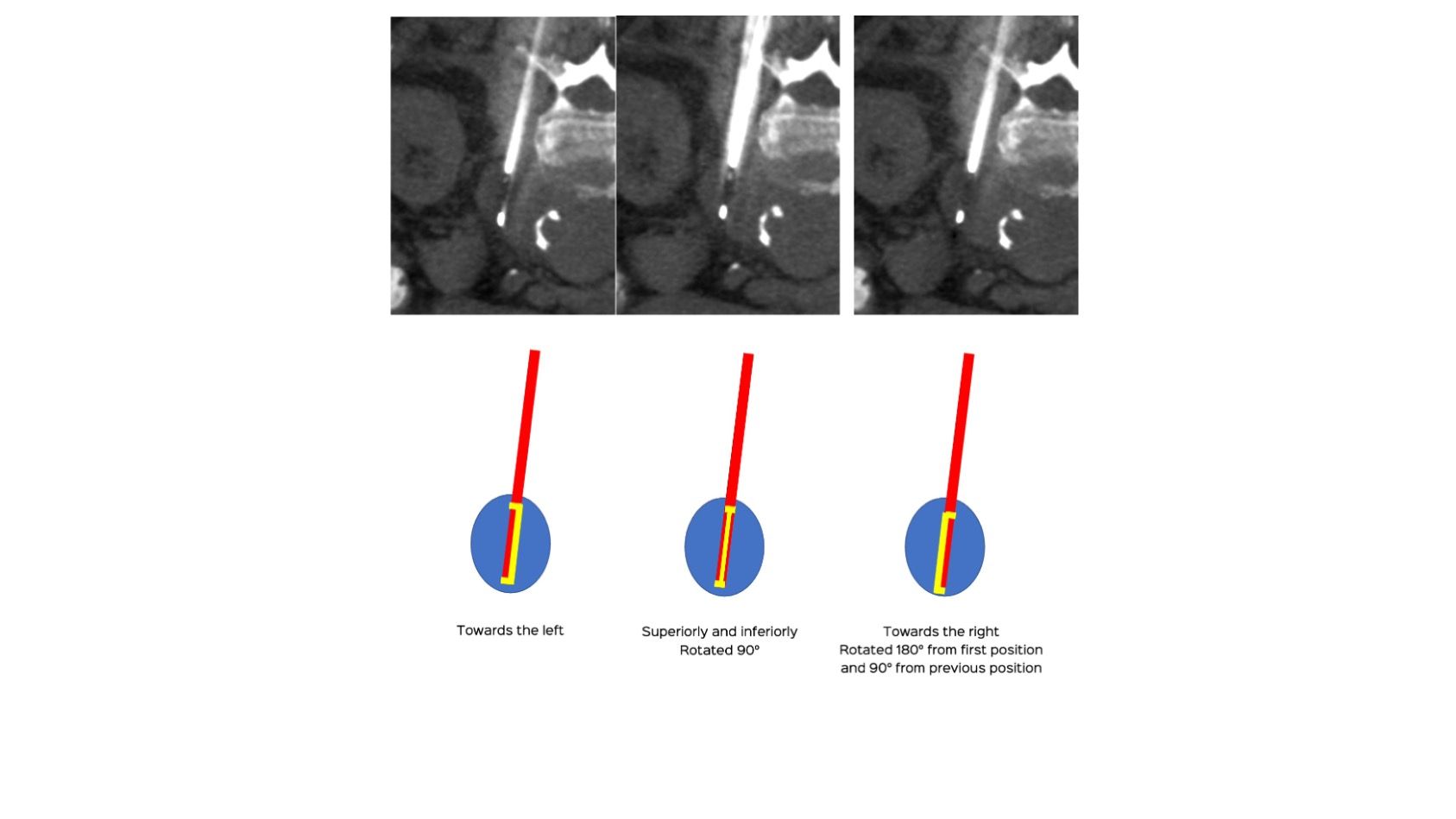 Case 93: Multidirectional Rotation of the Biopsy Needle for Better Sampling - Left Para-Aortic Retroperitoneal Node Biopsy