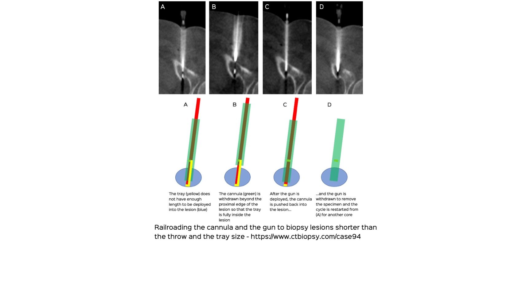 Case 94: Railroading the Gun and the Cannula to Biopsy Lesions Shorter than The Throw and the Tray Length