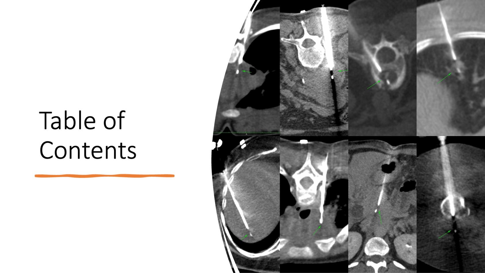 Case 143: Long Parallel Approach to Small Pleural Lesions