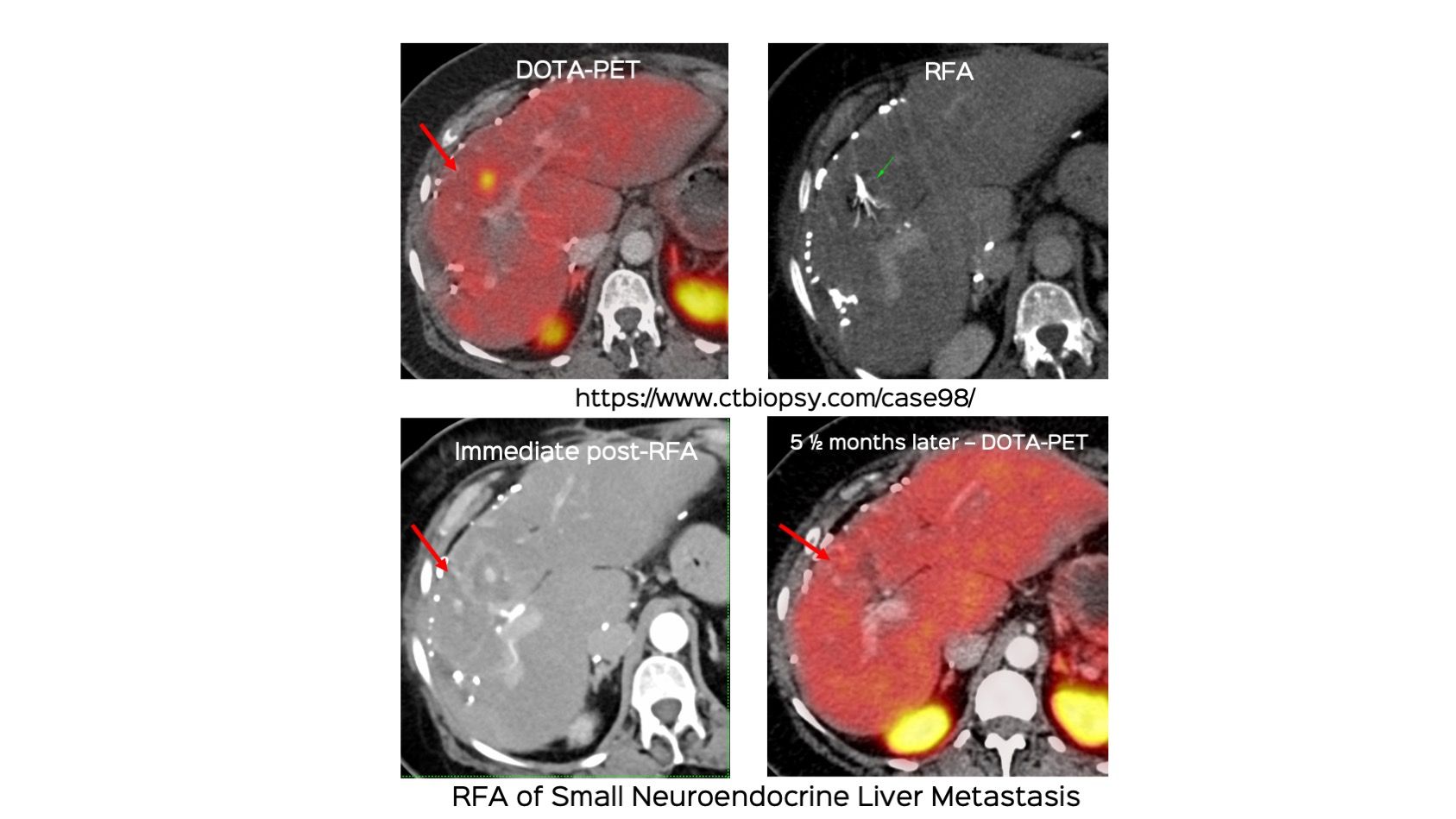 Case 98: Small Liver Lesion Radiofrequency Ablation (RFA)