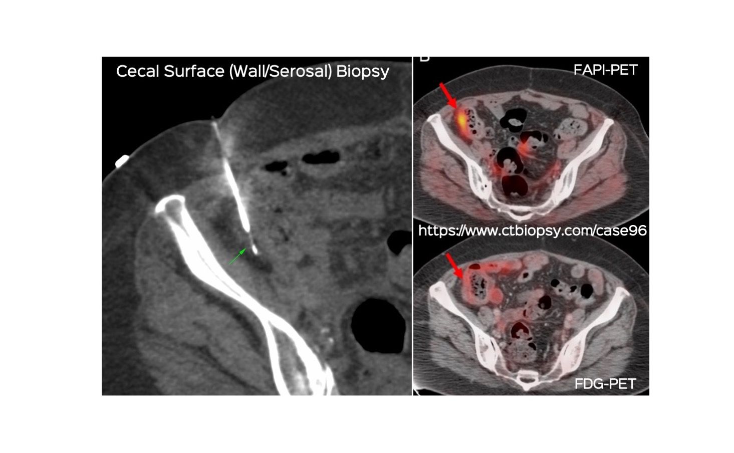 Case 96: Cecal Surface (Serosal/Wall) Biopsy (…and the value of FAPI-PET)