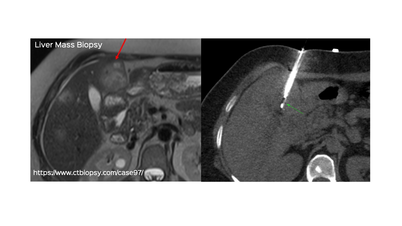 Case 97: Liver Mass Biopsy