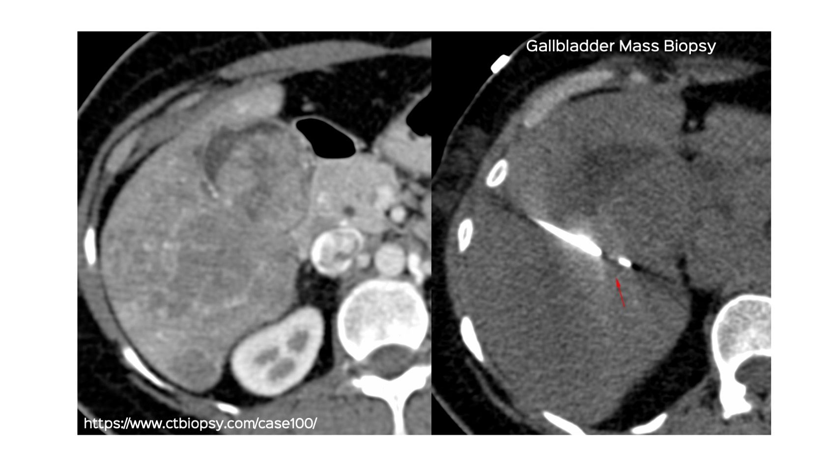 Case 100: Gallbladder Mass Biopsy