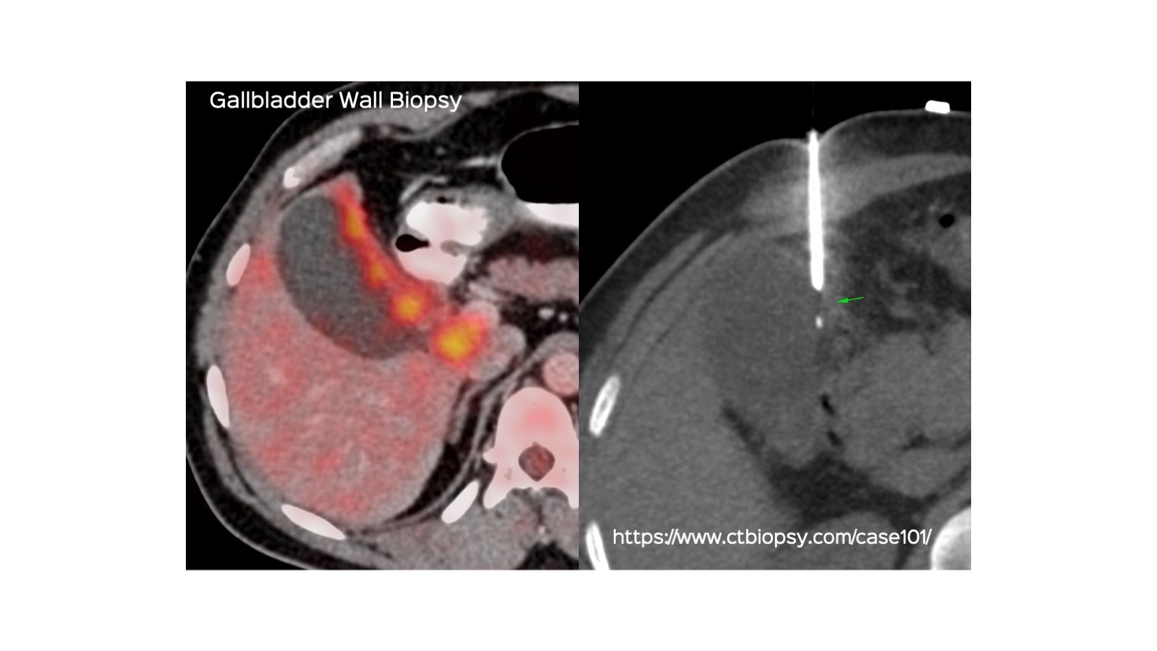 Case 101: Gallbladder Wall Biopsy