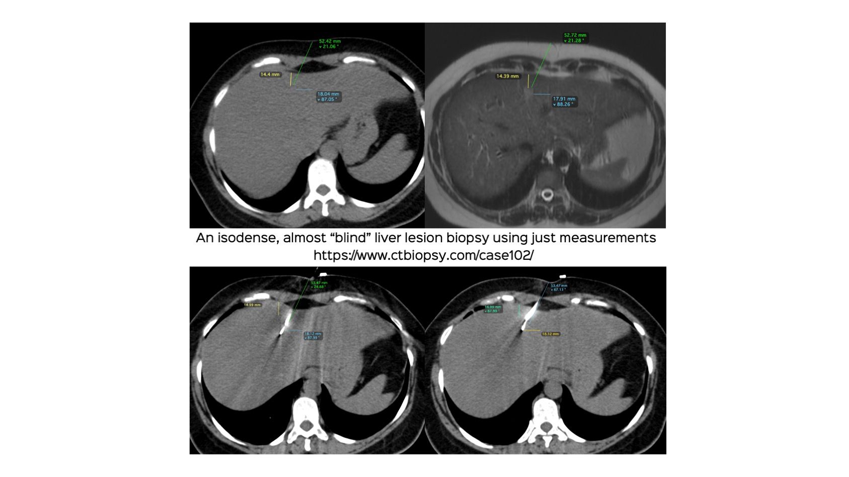 Case 102: Almost Blind Liver Lesion Biopsy using Just Measurements and Feel