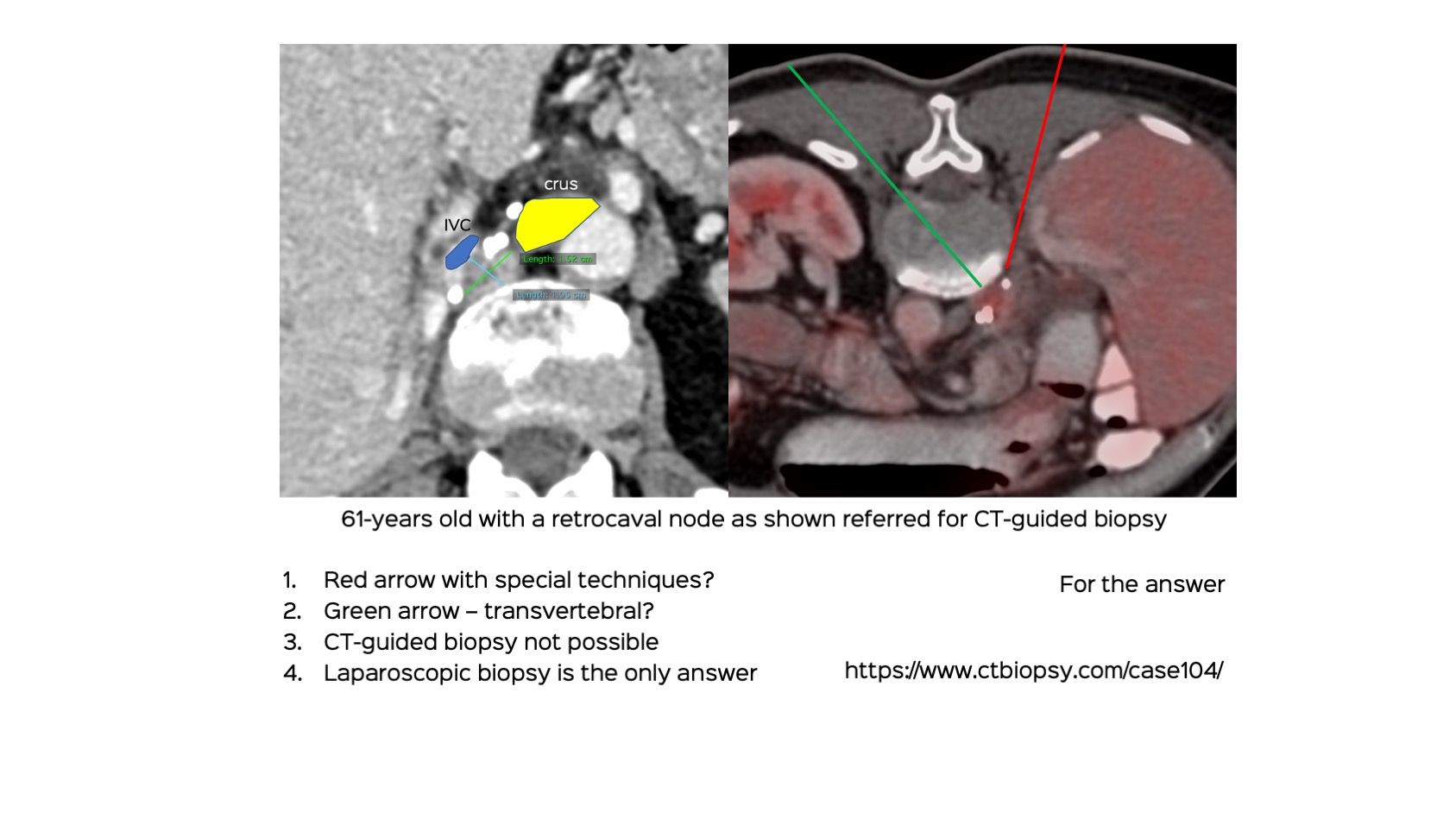 Case 104: Retrocaval Retroperitoneal Node Biopsy